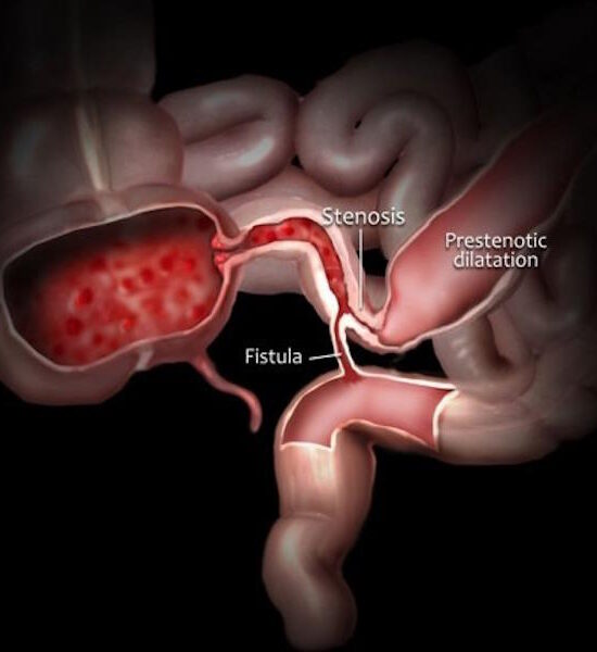 crohn's disease
